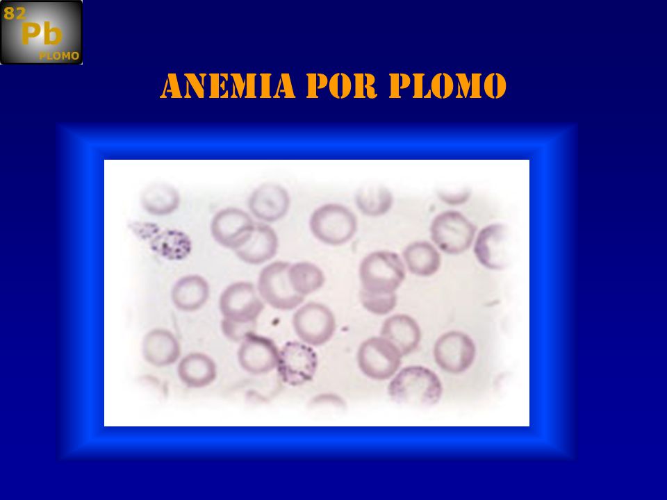 Anemia por plomo Es frecuente la anemia leve Normocítica e hipocrómica