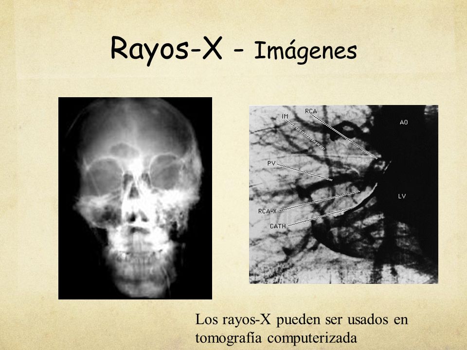 Rayos-X - Imágenes Add images!!! Los rayos-X pueden ser usados en tomografía computerizada