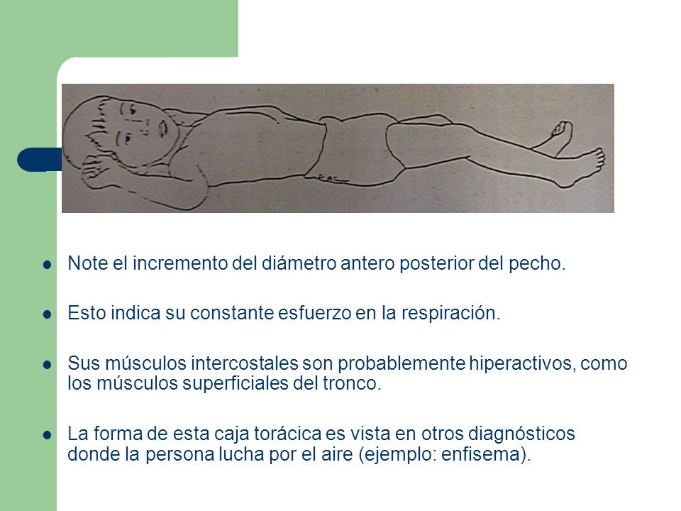 Note el incremento del diámetro antero posterior del pecho.
