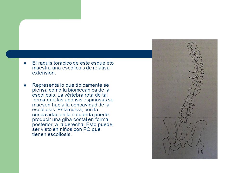 El raquis torácico de este esqueleto muestra una escoliosis de relativa extensión.