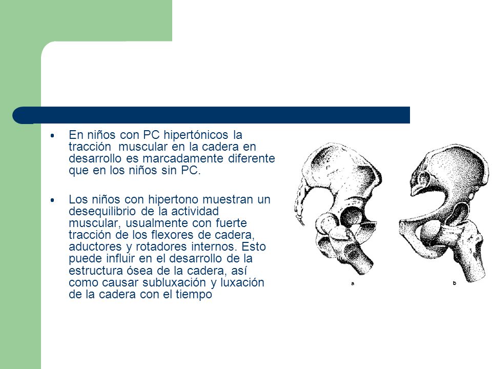En niños con PC hipertónicos la tracción muscular en la cadera en desarrollo es marcadamente diferente que en los niños sin PC.
