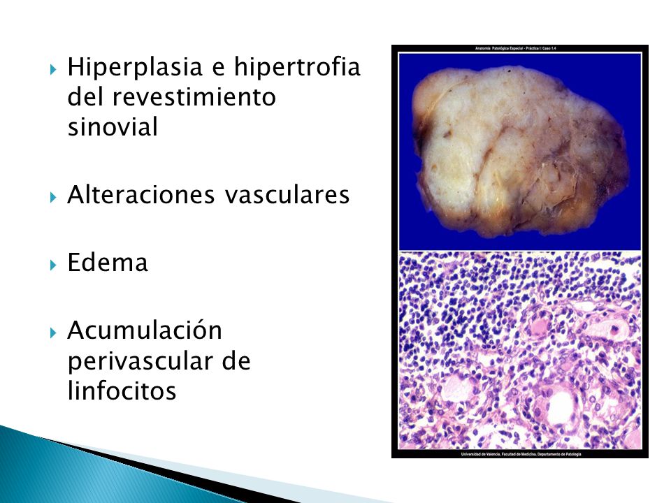 Hiperplasia e hipertrofia del revestimiento sinovial