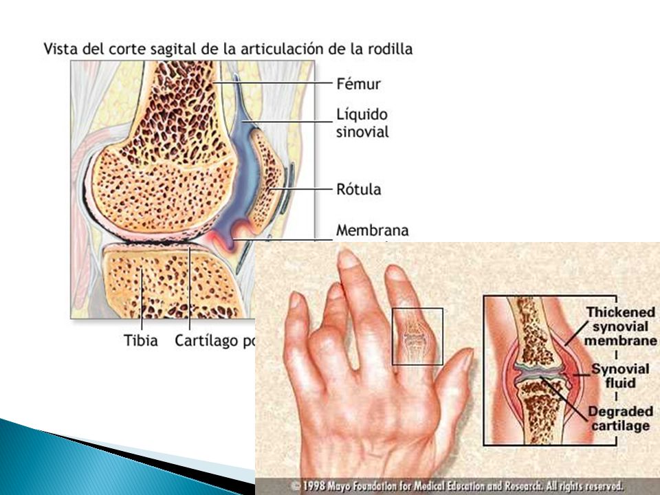 EL dolor se oriniga predominantemente de la capsula articualr, que esta m,uy inervada por fibrasnerviosas, es muy sensible al estiramiento y a la distension.
