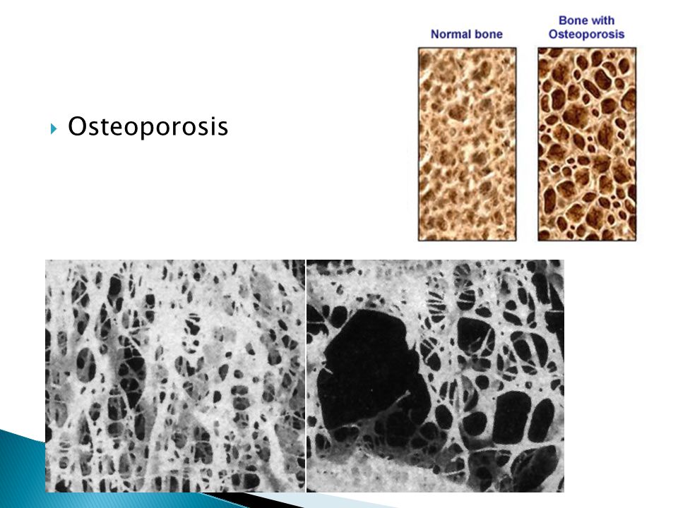 Osteoporosis Secundaria al aumento de la actividad osteoclastica y se agrava con el uso de glucocorticoides.