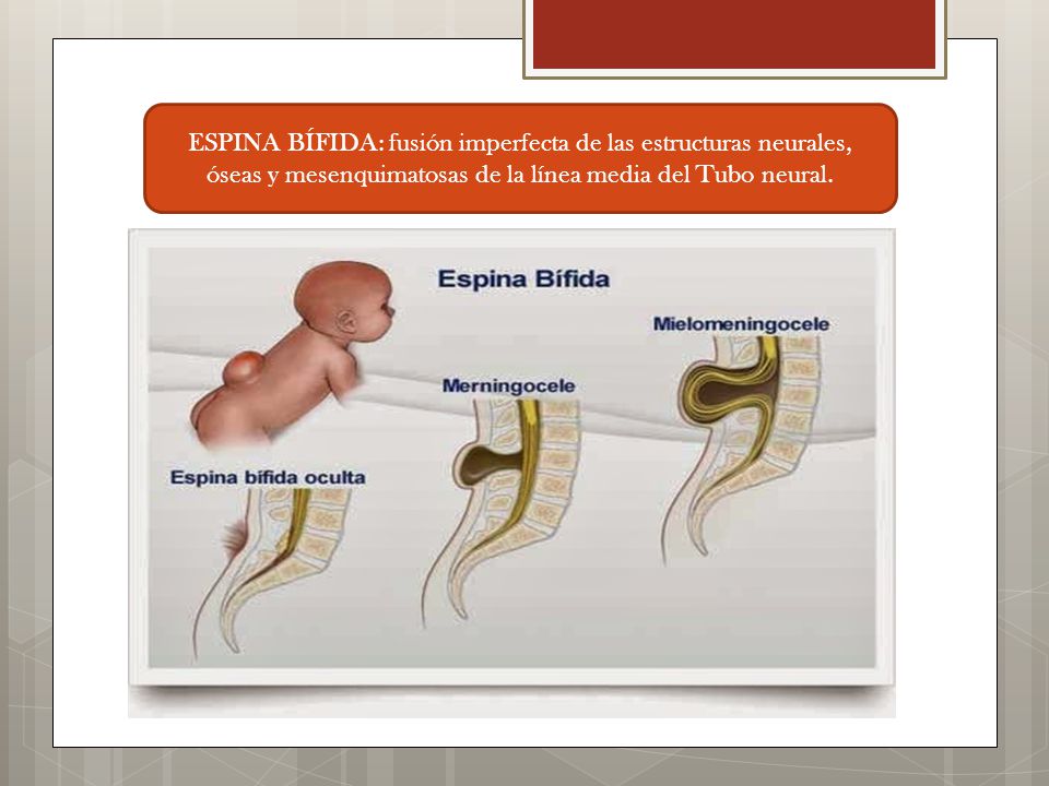 ESPINA BÍFIDA: fusión imperfecta de las estructuras neurales, óseas y mesenquimatosas de la línea media del Tubo neural.