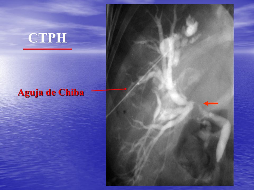 CTPH Aguja de Chiba