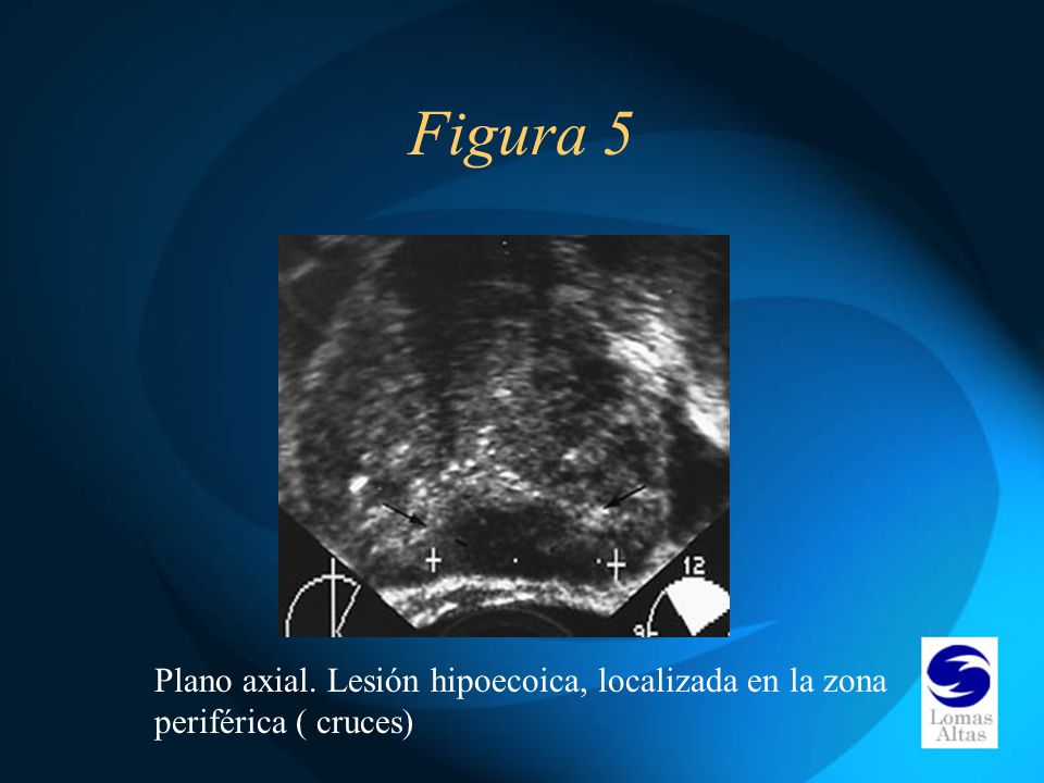 Figura 5 Plano axial. Lesión hipoecoica, localizada en la zona periférica ( cruces)