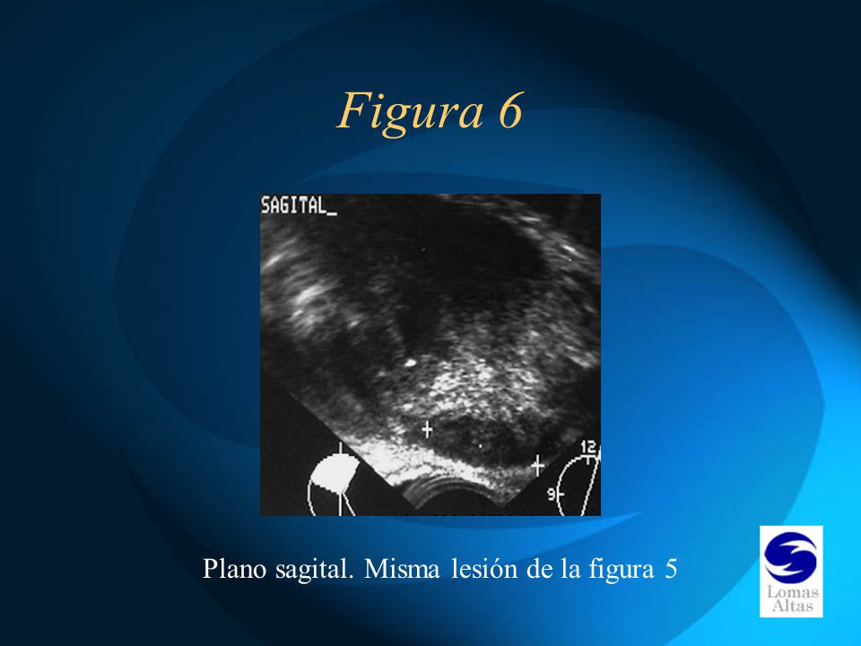 Figura 6 Plano sagital. Misma lesión de la figura 5