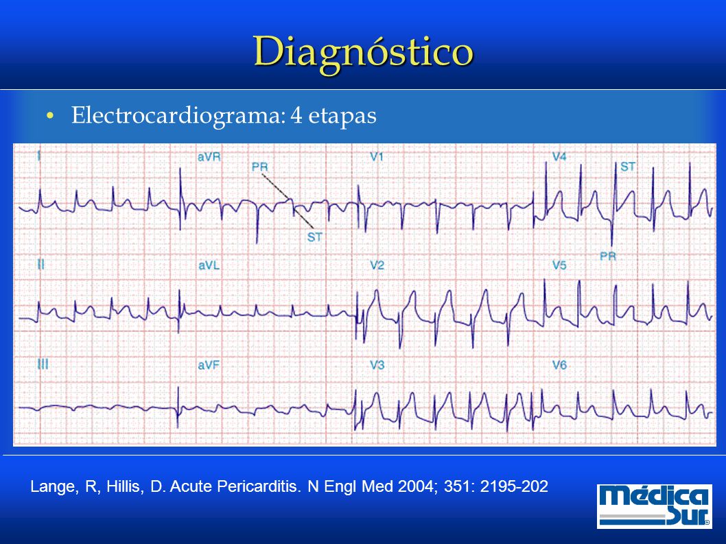Diagnóstico Electrocardiograma: 4 etapas