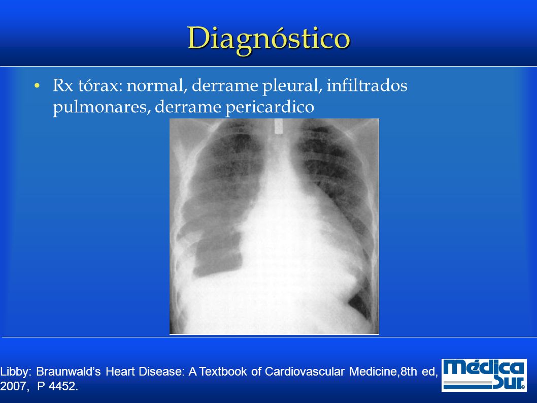 Diagnóstico Rx tórax: normal, derrame pleural, infiltrados pulmonares, derrame pericardico.