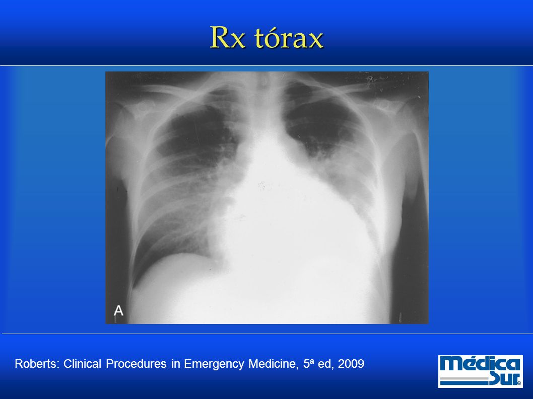 Rx tórax Roberts: Clinical Procedures in Emergency Medicine, 5ª ed, 2009