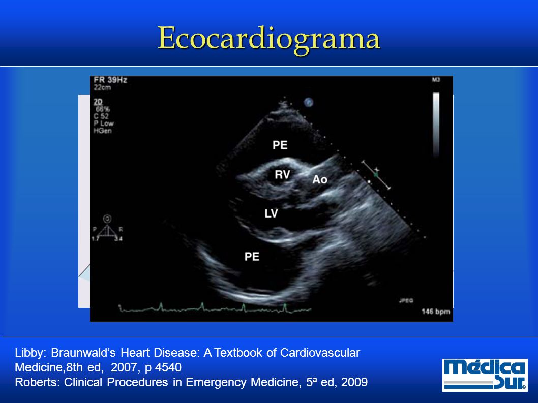 Ecocardiograma Libby: Braunwald’s Heart Disease: A Textbook of Cardiovascular Medicine,8th ed, 2007, p