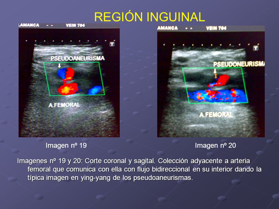 REGIÓN INGUINAL Imagen nº 19 Imagen nº 20
