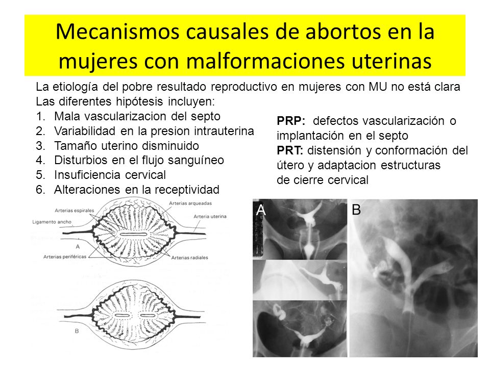 Mecanismos causales de abortos en la mujeres con malformaciones uterinas