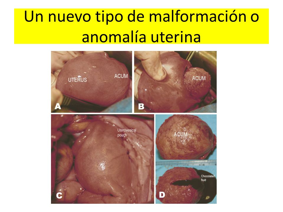Un nuevo tipo de malformación o anomalía uterina