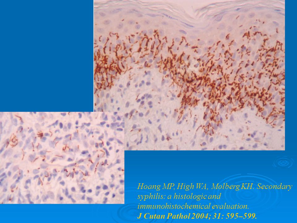 Hoang MP, High WA, Molberg KH. Secondary syphilis: a histologic and
