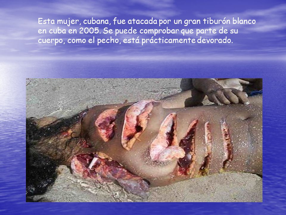 Esta mujer, cubana, fue atacada por un gran tiburón blanco en cuba en 2005.
