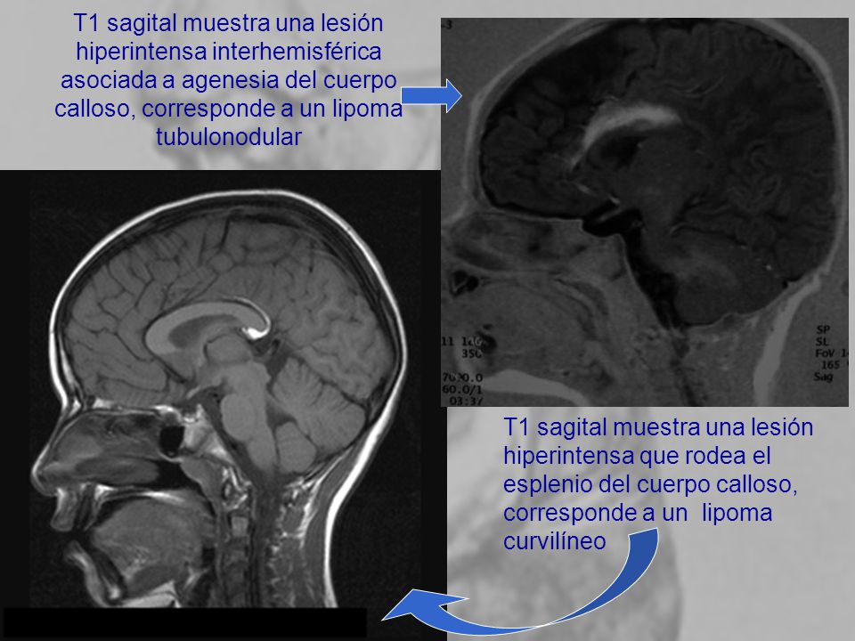 T1 sagital muestra una lesión hiperintensa interhemisférica asociada a agenesia del cuerpo calloso, corresponde a un lipoma tubulonodular