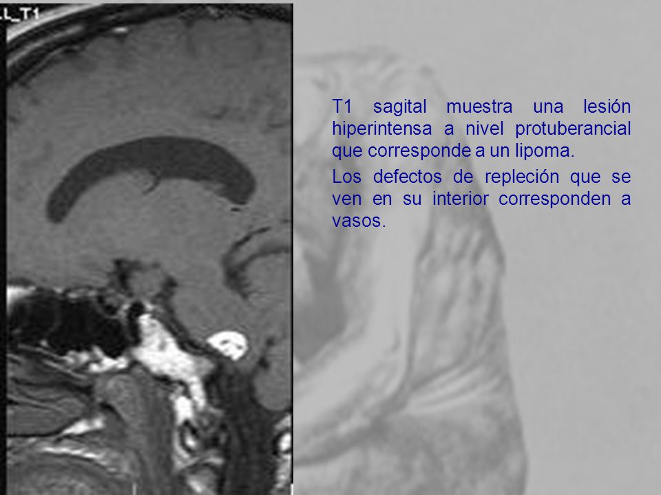 T1 sagital muestra una lesión hiperintensa a nivel protuberancial que corresponde a un lipoma.