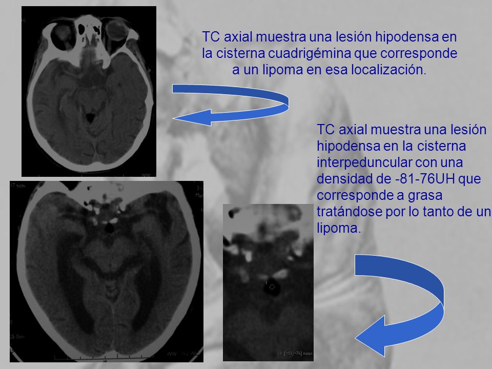TC axial muestra una lesión hipodensa en la cisterna cuadrigémina que corresponde a un lipoma en esa localización.