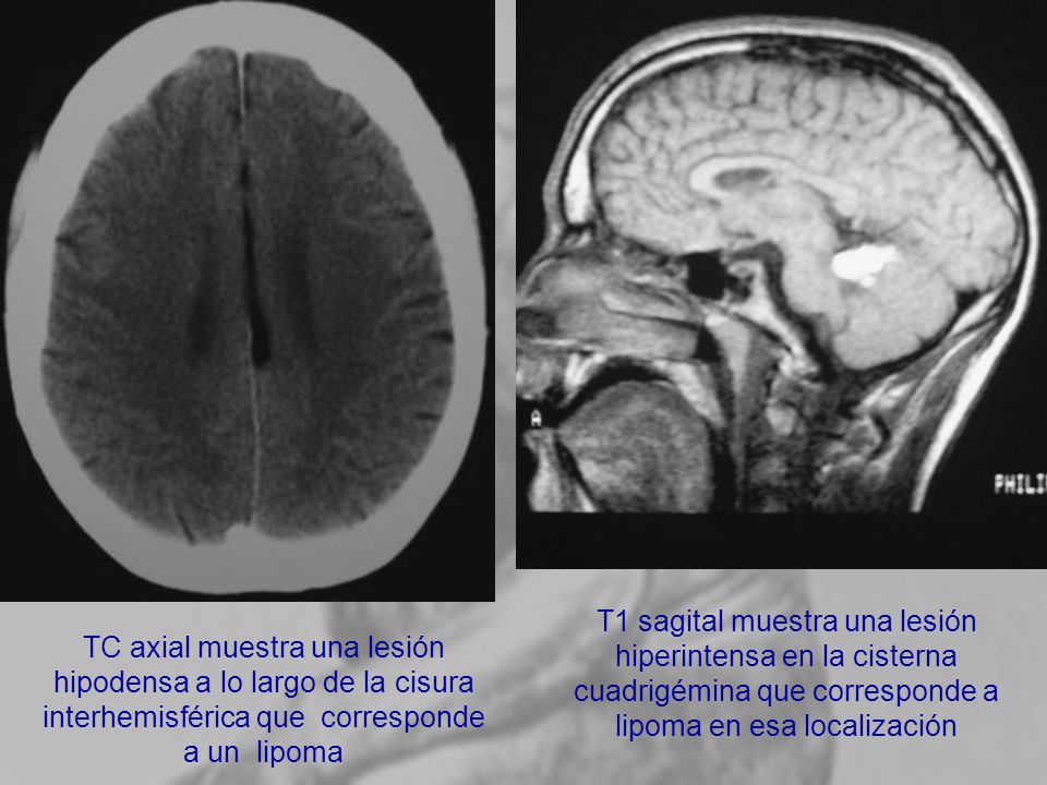 T1 sagital muestra una lesión hiperintensa en la cisterna cuadrigémina que corresponde a lipoma en esa localización