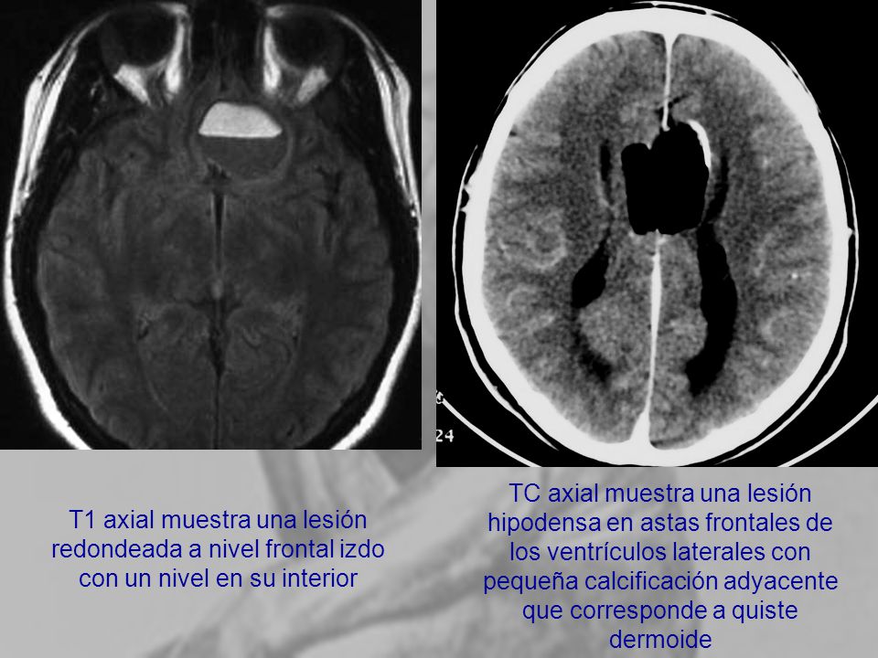 T1 axial muestra una lesión redondeada a nivel frontal izdo con un nivel en su interior