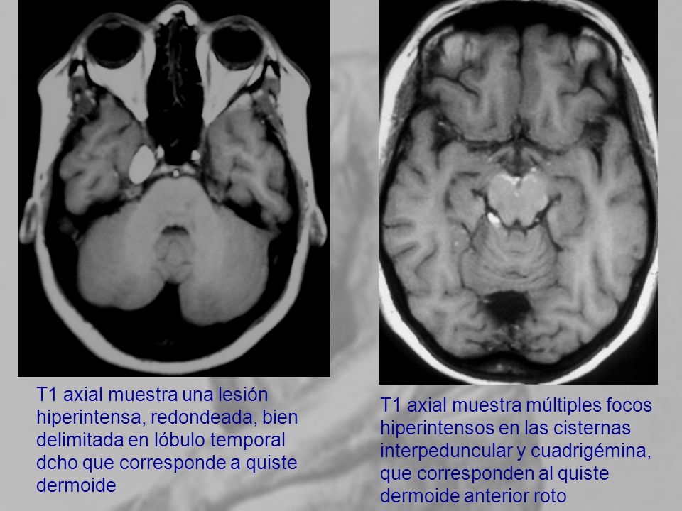 T1 axial muestra una lesión hiperintensa, redondeada, bien delimitada en lóbulo temporal dcho que corresponde a quiste dermoide