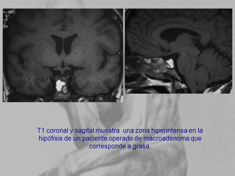 T1 coronal y sagital muestra una zona hiperintensa en la hipófisis de un paciente operado de macroadenoma que corresponde a grasa.