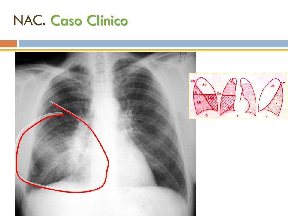 NAC. Caso Clínico