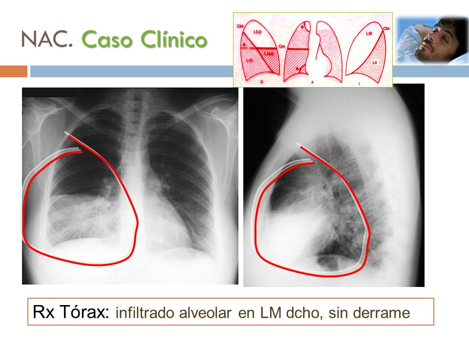 NAC. Caso Clínico Rx Tórax: infiltrado alveolar en LM dcho, sin derrame