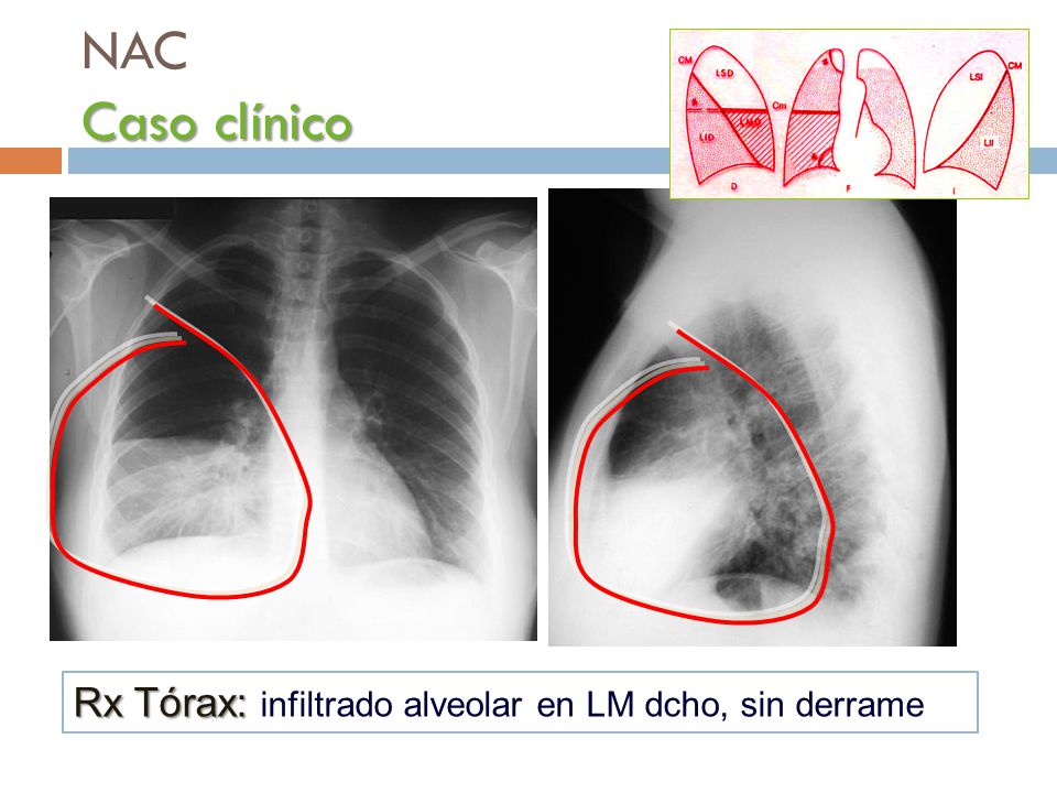 NAC Caso clínico Rx Tórax: infiltrado alveolar en LM dcho, sin derrame