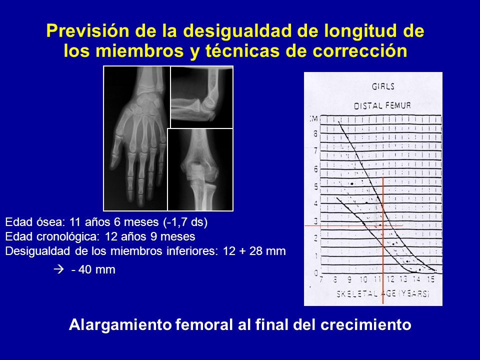 Previsión de la desigualdad de longitud de los miembros y técnicas de corrección