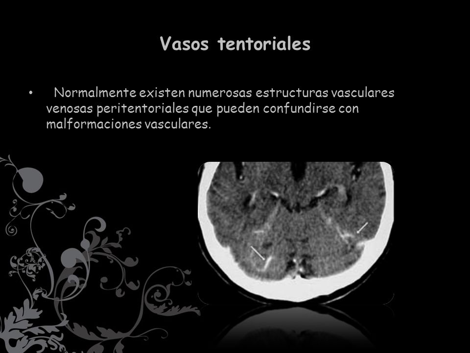 Vasos tentoriales Normalmente existen numerosas estructuras vasculares venosas peritentoriales que pueden confundirse con malformaciones vasculares.