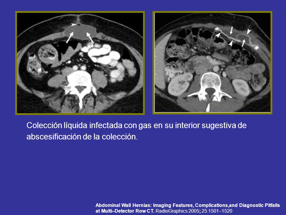 Colección líquida infectada con gas en su interior sugestiva de