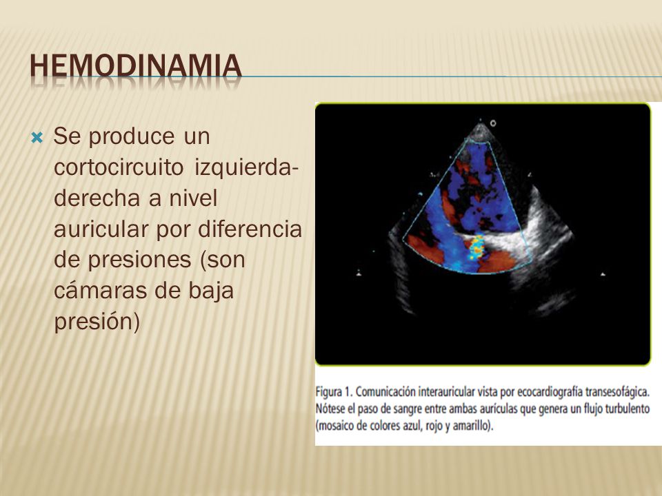 Hemodinamia Se produce un cortocircuito izquierda-derecha a nivel auricular por diferencia de presiones (son cámaras de baja presión)
