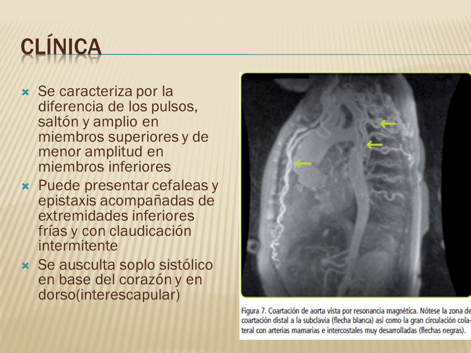 clínica Se caracteriza por la diferencia de los pulsos, saltón y amplio en miembros superiores y de menor amplitud en miembros inferiores.