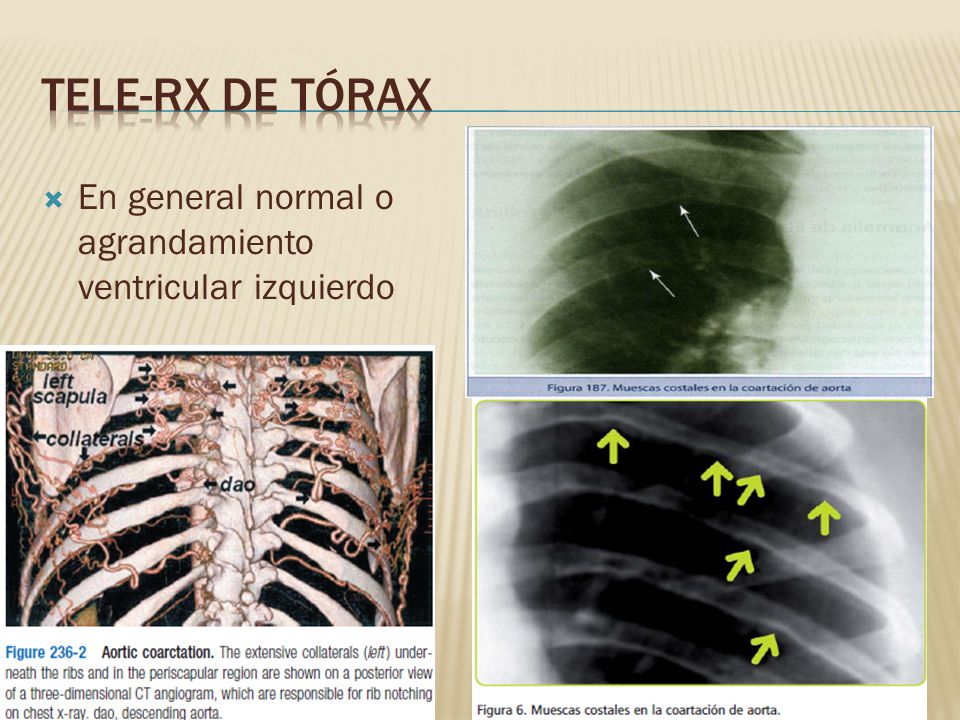 Tele-Rx de tórax En general normal o agrandamiento ventricular izquierdo Signo de ROESLER
