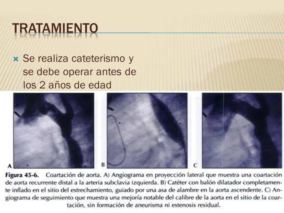Tratamiento Se realiza cateterismo y se debe operar antes de los 2 años de edad