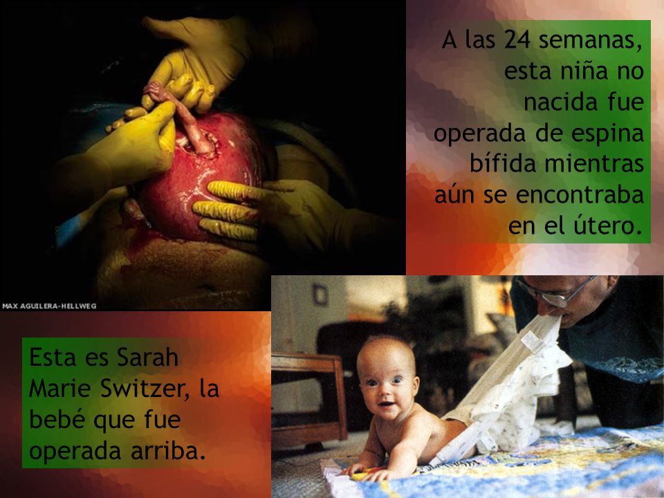 A las 24 semanas, esta niña no nacida fue operada de espina bífida mientras aún se encontraba en el útero.
