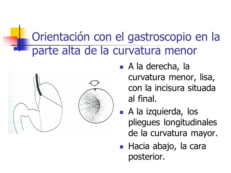 Orientación con el gastroscopio en la parte alta de la curvatura menor