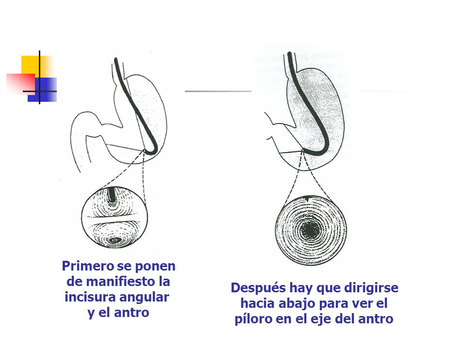 Después hay que dirigirse píloro en el eje del antro