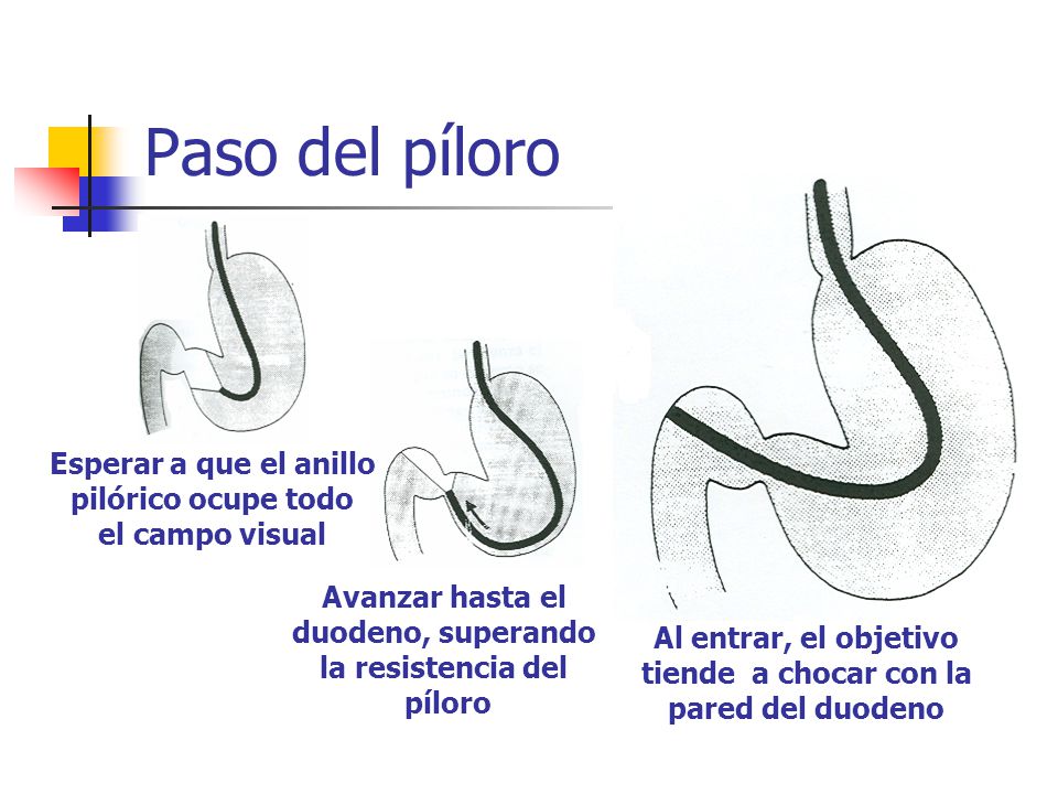 Paso del píloro Esperar a que el anillo pilórico ocupe todo