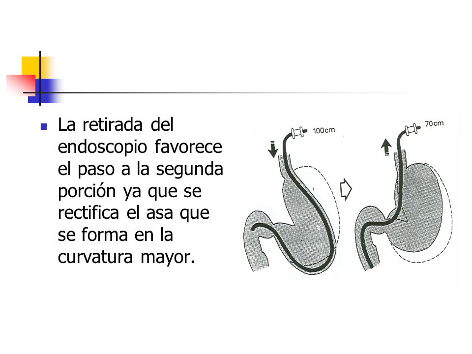 La retirada del endoscopio favorece el paso a la segunda porción ya que se rectifica el asa que se forma en la curvatura mayor.