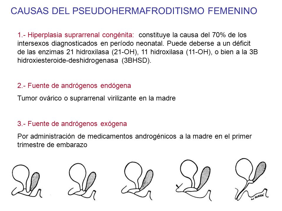 CAUSAS DEL PSEUDOHERMAFRODITISMO FEMENINO
