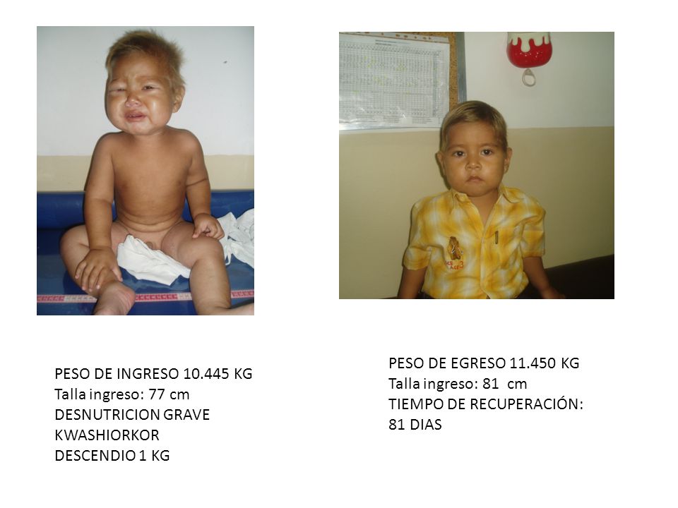 PESO DE EGRESO KG Talla ingreso: 81 cm. TIEMPO DE RECUPERACIÓN: 81 DIAS. PESO DE INGRESO KG.