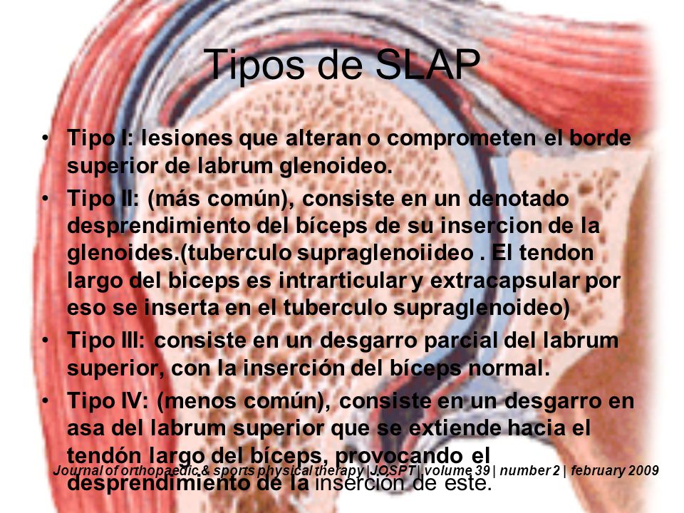 Tipos de SLAP Tipo I: lesiones que alteran o comprometen el borde superior de labrum glenoideo.