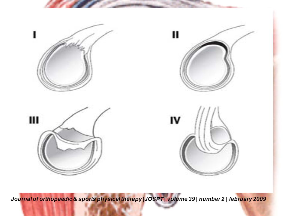 Journal of orthopaedic & sports physical therapy |JOSPT | volume 39 | number 2 | february 2009