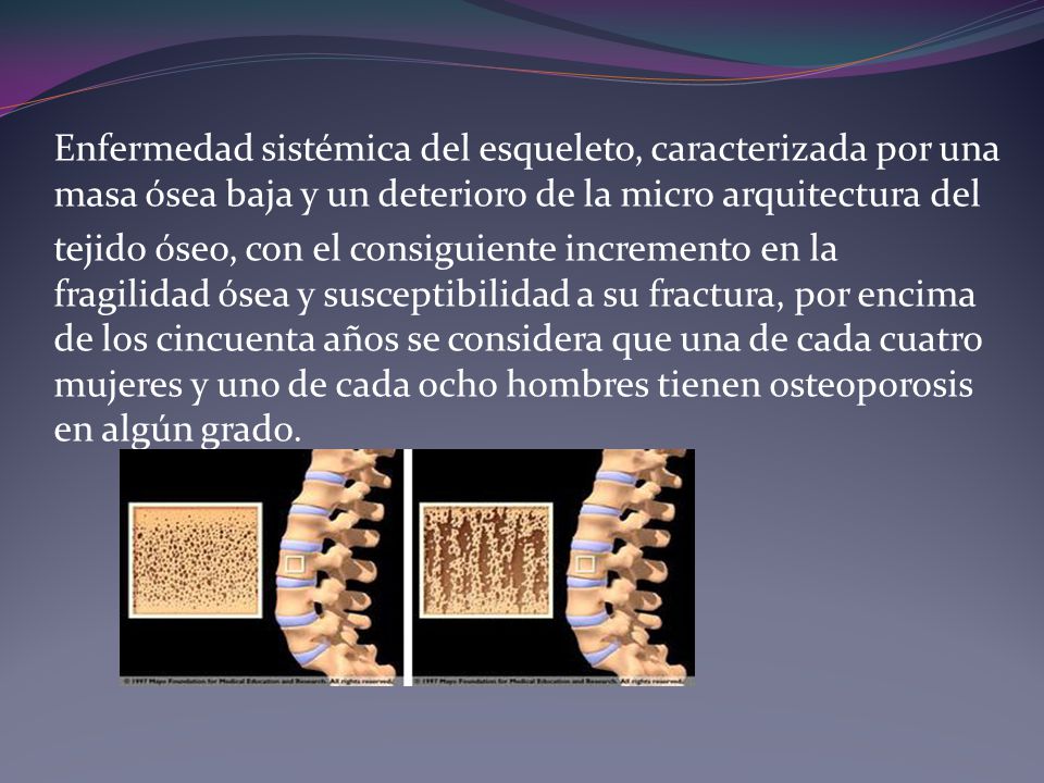 Enfermedad sistémica del esqueleto, caracterizada por una masa ósea baja y un deterioro de la micro arquitectura del