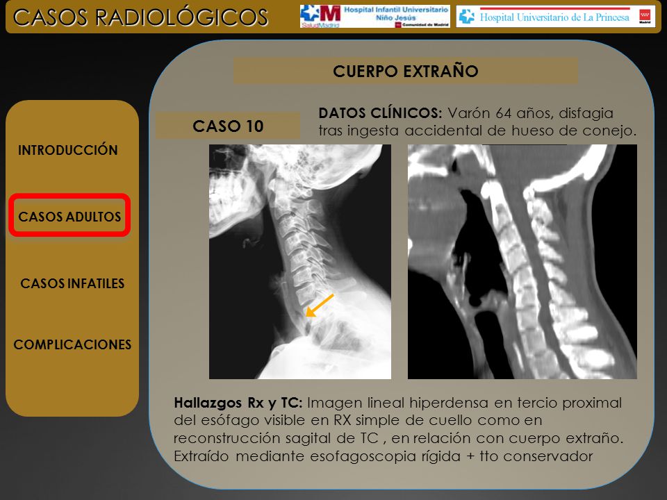 CASOS RADIOLÓGICOS CUERPO EXTRAÑO CASO 10