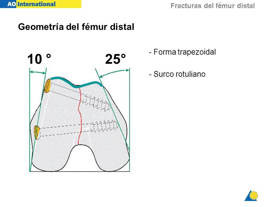 10 ° 25° Geometría del fémur distal - Forma trapezoidal